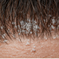 Rasune ja kuiv kõõm